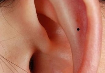 常見30種身上痣 影響婚姻財運