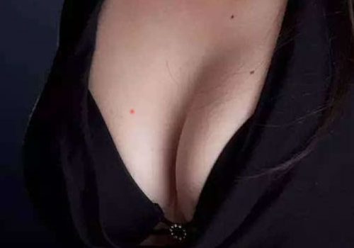 乳房上長紅痣有什麼預兆 和血痣的區別