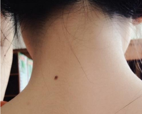 哪些痣不能取 胸部脖子肚子