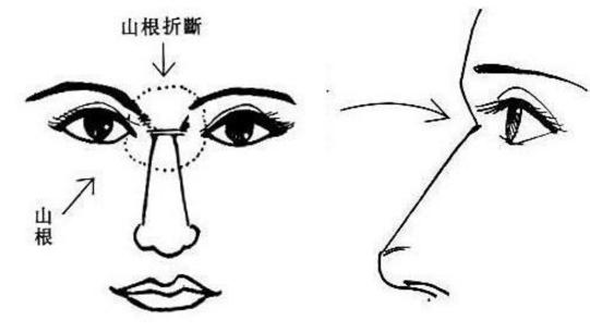 男人克妻痣長在哪裡 點了能不克妻嗎