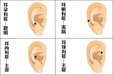 常見30種身上痣 影響婚姻財運