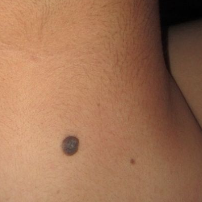 男脖子後面有痣代表什麼 身體哪個部位長痣好