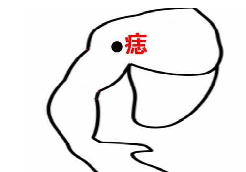 活痣是吉是凶 和死痣的區別