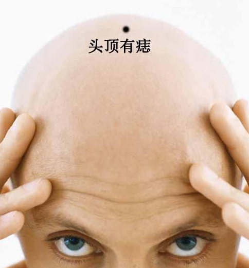 貴人痣長在什麼地方 頭頂右眉背部