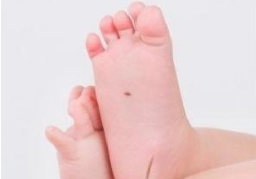 腳底中心長痣代表什麼 好不好