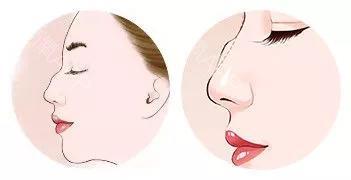 女人駝峰鼻面命運解釋駝峰鼻女人是旺夫命嗎？