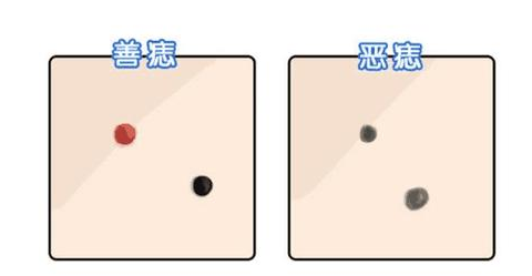 財富痣長在哪 耳垂眉眼間大陽穴