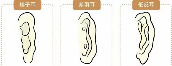 耳相16種圖解 各種耳朵形狀看富貴命運